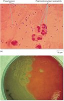 Pneumococci in sputum and blood agar culture