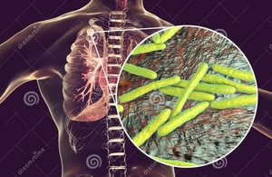 Mycobacterium tuberculosis in the lung