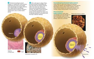 Secondary/disseminated tuberculosis and granuloma formation