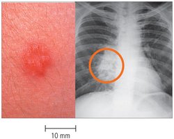Tuberculin skin test and chest X-ray for TB diagnosis