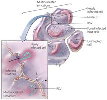 RSV-induced syncytium formation in lung tissue