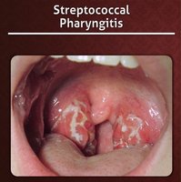 Streptococcal pharyngitis with white exudate on tonsils