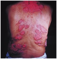Coccidioidomycosis lesions in subcutaneous tissue