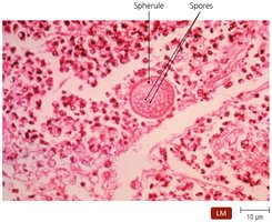 Spherules of Coccidioides immitis in lung tissue