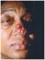 Cutaneous blastomycosis lesions