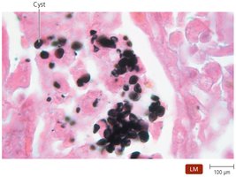 Cysts of Pneumocystis jirovecii in lung tissue