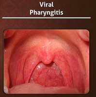 Viral pharyngitis with red, inflamed throat but no exudate