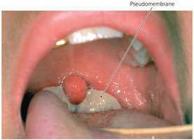 Pseudomembrane in diphtheria