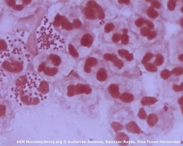 Gram stain of Neisseria gonorrhoeae