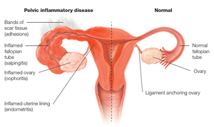 Pelvic inflammatory disease vs. normal female reproductive tract
