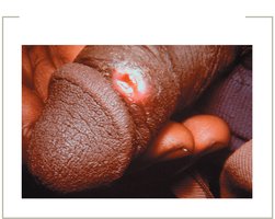 Primary syphilis chancre on genitalia