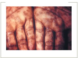 Secondary syphilis rash on hands