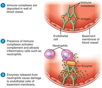 Immune complex-mediated hypersensitivity