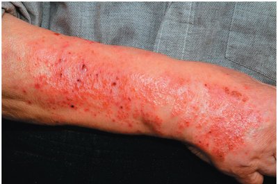 Contact dermatitis on skin