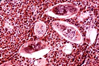 Eosinophils attacking parasites