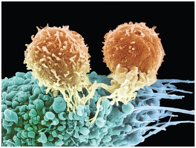 Lymphocytes attacking a cancer cell (immune response)