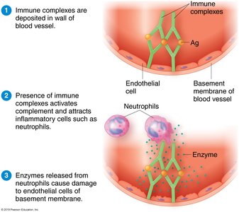 Immune complex deposition and inflammation