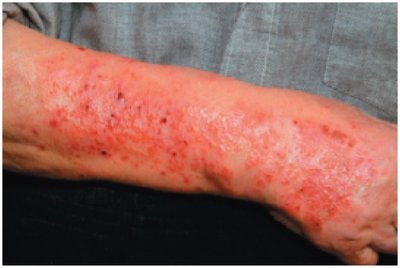 Contact dermatitis on arm