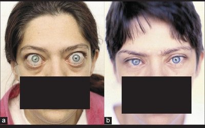 Symptoms of Graves' disease