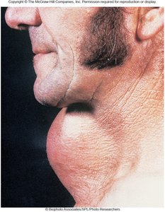 Exophthalmos in Graves' disease