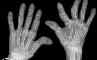 X-ray of rheumatoid arthritis