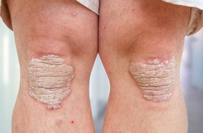 Psoriasis on knees