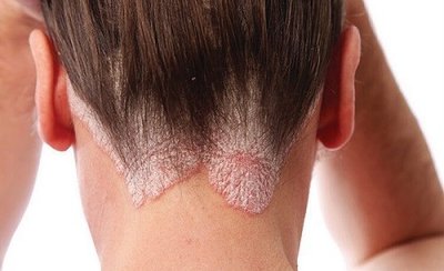 Psoriasis on scalp