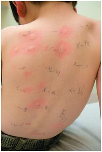 Skin test for allergies showing wheals