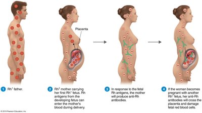 Diagram of hemolytic disease of the newborn