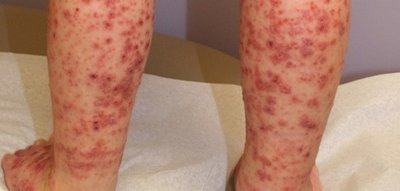 Thrombocytopenic purpura on legs