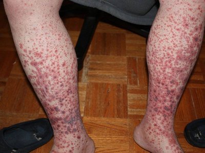 Thrombocytopenic purpura on legs