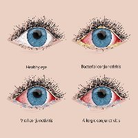 Comparison of healthy eye and types of conjunctivitis