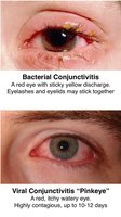 Bacterial vs viral conjunctivitis clinical images