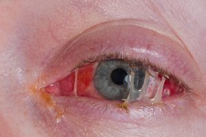 Close-up of purulent discharge in bacterial conjunctivitis