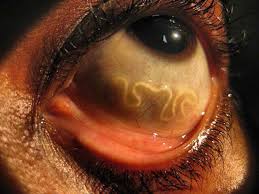 Loa loa worm visible in the eye