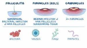 Diagram comparing folliculitis, furuncles, and carbuncles