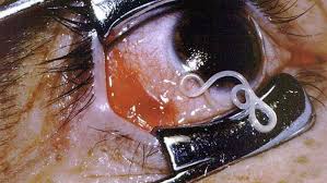 Surgical removal of Loa loa worm from the eye