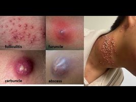 Clinical images of folliculitis, furuncle, carbuncle, and abscess