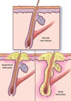 Diagram of normal, superficial, and deep folliculitis