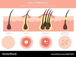 Diagram of boil (furuncle) progression