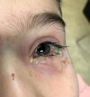 Eye with purulent discharge in bacterial conjunctivitis
