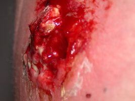 MRSA infection