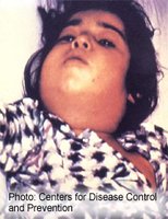 Corynebacterium diphtheriae infection