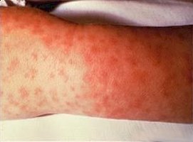 Rickettsia infection in tick hemolymph
