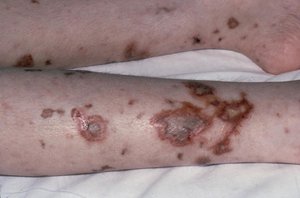 Neisseria infection