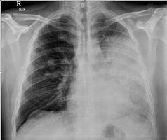 Legionella infection