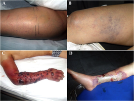 Vibrio necrotising fasciitis