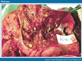 Pseudomonas aeruginosa lung infection
