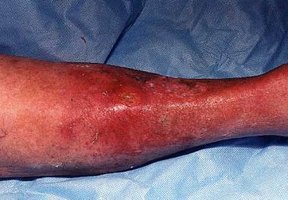 Cellulitis on lower leg