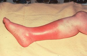 Cellulitis with extensive redness